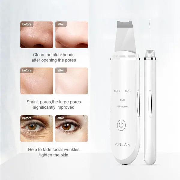 Ultrasonic Skin Lift Machine,,The Gift Dimension
